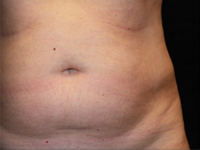 Patient #86533: Liposuction Before Image
