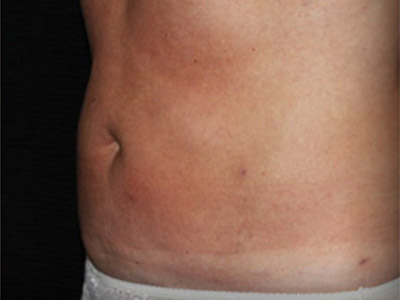 Patient #86533: Liposuction After Image