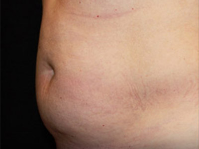Patient #86533: Liposuction Before Image