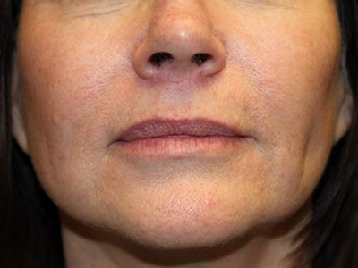 Patient #05970: Mini-Facelift After Image