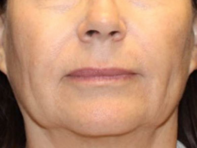 Patient #05970: Mini-Facelift Before Image