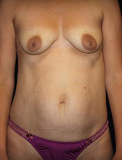Patient #30498: Mommy Makeover Before Image