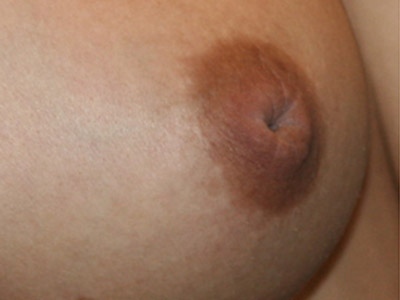 Patient #98615: Nipple Inversion Before Image