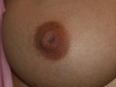 Patient #98615: Nipple Inversion Before Image