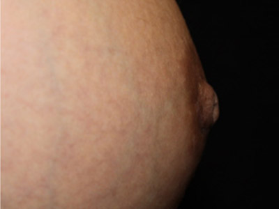 Patient #98615: Nipple Inversion After Image