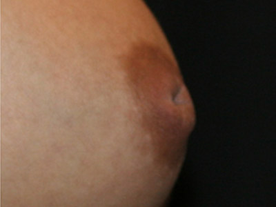 Patient #98615: Nipple Inversion Before Image