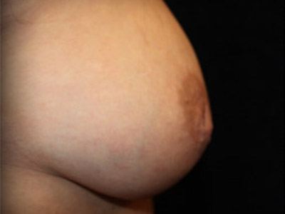 Patient #36612: Nipple Inversion Before Image