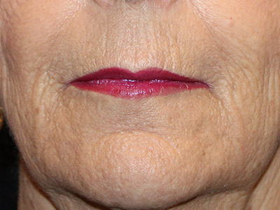 Patient #83575: Resurfacing After Image