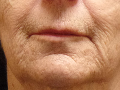 Patient #83575: Resurfacing Before Image