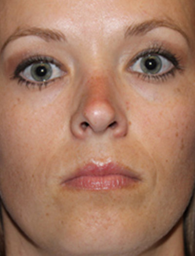 Patient #43620: Rhinoplasty After Image