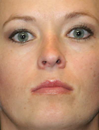 Patient #43620: Rhinoplasty Before Image