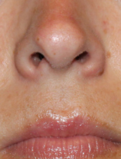 Patient #43620: Rhinoplasty After Image
