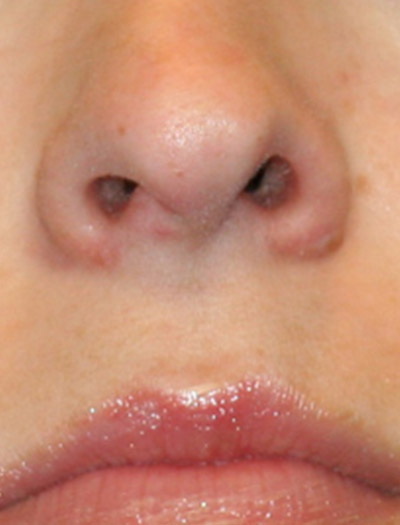 Patient #43620: Rhinoplasty Before Image