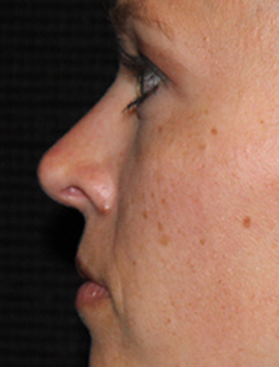 Patient #43620: Rhinoplasty After Image