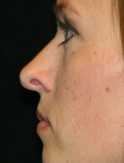 Patient #43620: Rhinoplasty Before Image