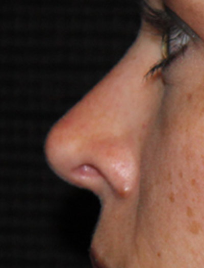 Patient #43620: Rhinoplasty After Image