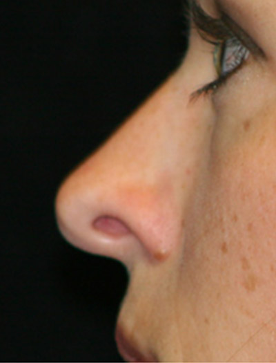 Patient #43620: Rhinoplasty Before Image