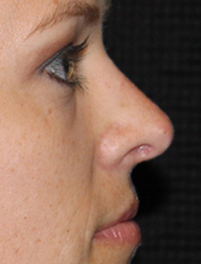 Patient #43620: Rhinoplasty After Image