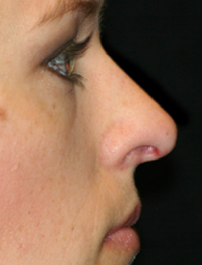 Patient #43620: Rhinoplasty Before Image