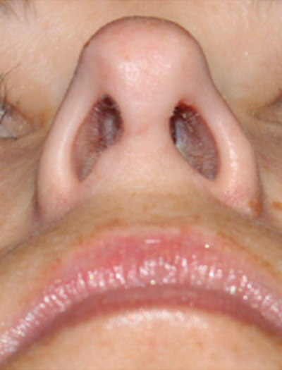 Patient #43620: Rhinoplasty After Image