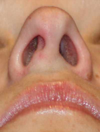 Patient #43620: Rhinoplasty Before Image