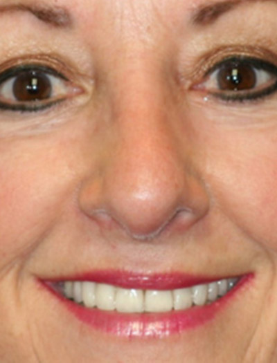 Patient #97357: Rhinoplasty After Image