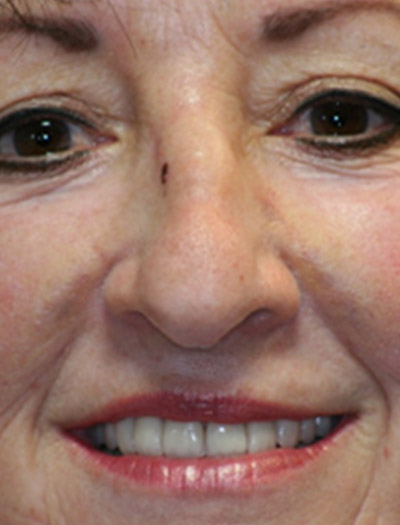 Patient #97357: Rhinoplasty Before Image