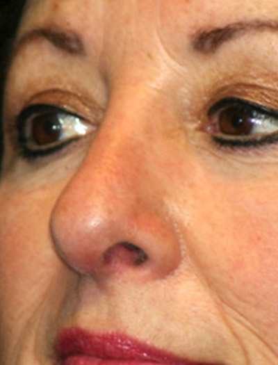 Patient #97357: Rhinoplasty After Image