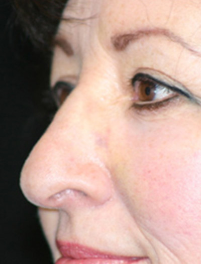 Patient #97357: Rhinoplasty Before Image
