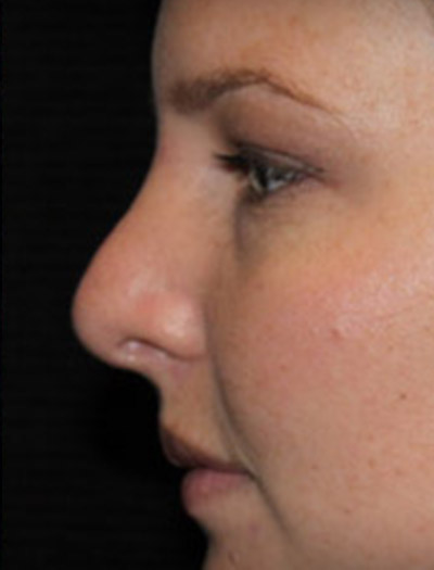 Patient #03134: Rhinoplasty After Image
