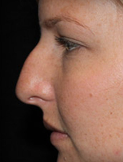 Patient #03134: Rhinoplasty Before Image
