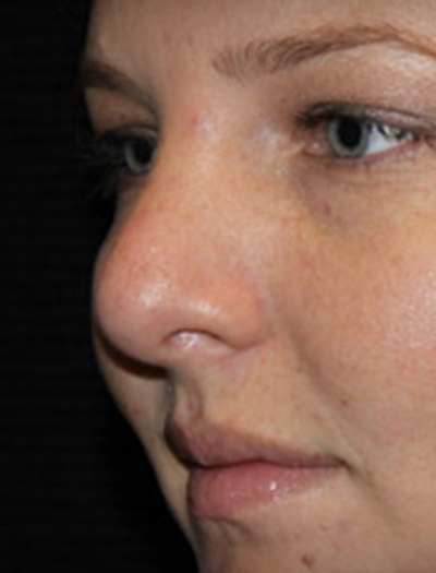 Patient #03134: Rhinoplasty After Image