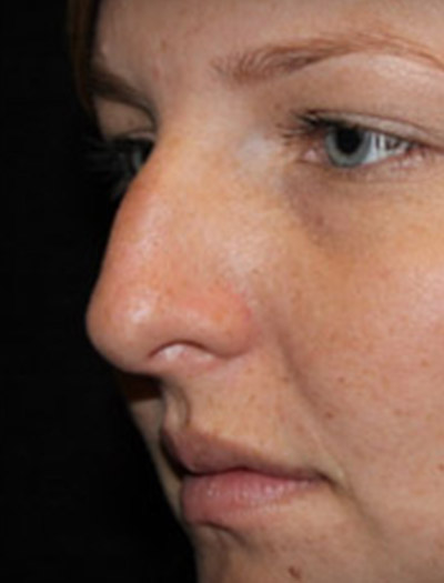 Patient #03134: Rhinoplasty Before Image