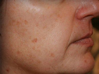 Patient #51961: Sunspots Before Image