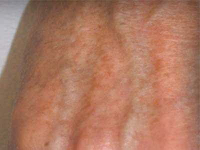 Patient #71220: Sunspots After Image