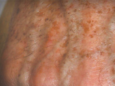 Patient #71220: Sunspots Before Image