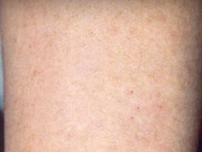 Patient #94929: Sunspots After Image