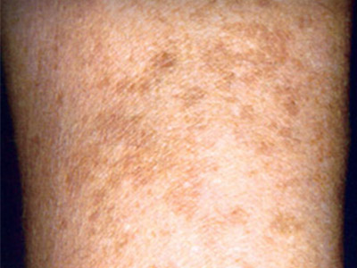 Patient #94929: Sunspots Before Image