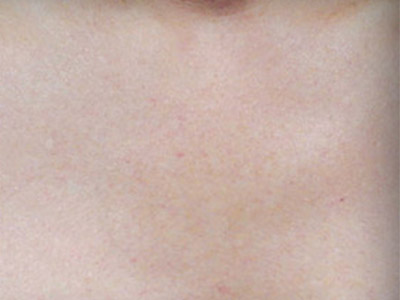 Patient #12539: Sunspots After Image