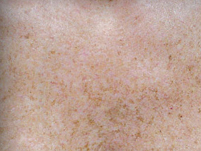 Patient #12539: Sunspots Before Image