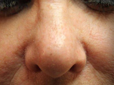 Patient #74443: Sunspots After Image