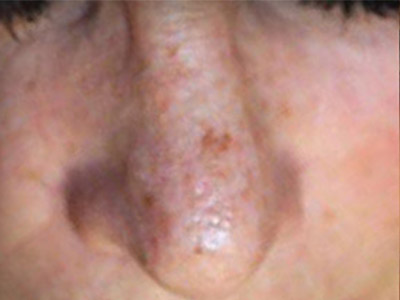 Patient #74443: Sunspots Before Image