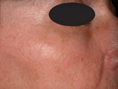 Patient #05387: Wrinkle Treatment After Image