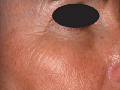 Patient #05387: Wrinkle Treatment Before Image