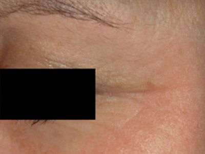 Patient #90912: Wrinkle Treatment After Image