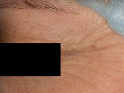 Patient #90912: Wrinkle Treatment Before Image