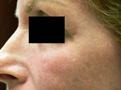 Patient #95416: Wrinkle Treatment After Image