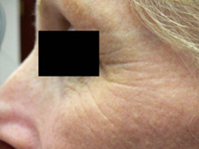 Patient #95416: Wrinkle Treatment Before Image
