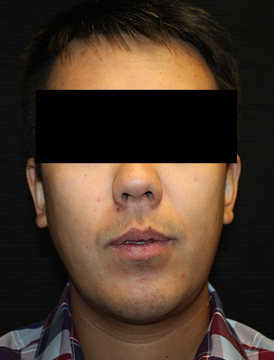 Patient #43730: Chin Augmentation After Image