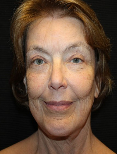 Patient #68494: Chin Augmentation After Image